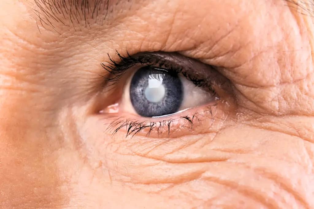 Close-up of an eye showing signs of glaucoma and optic nerve damage